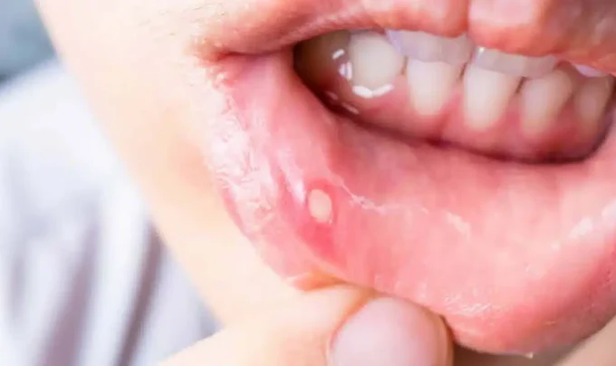 Mouth Ulcers: నోట్లో పుండ్లతో ఇబ్బంది పడుతున్నారా…ఈ చిన్న చిట్కాతో ఒక్క రోజులో తగ్గించుకోండి…!