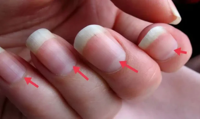 Nails: గోళ్లలో ఈ ఆకారాన్ని బట్టి మీ ఆరోగ్యం ఎలా ఉందో తెలుసుకోవచ్చు.ఎలా అంటే…!
