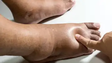Swollen Feet